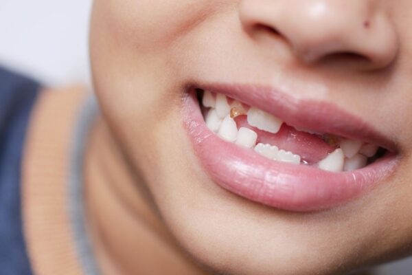 Dent définitive derrière une dent de lait : faut-il s’inquiéter ?