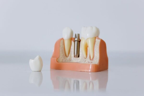 Dentier sans palais : modèles, indications et limites